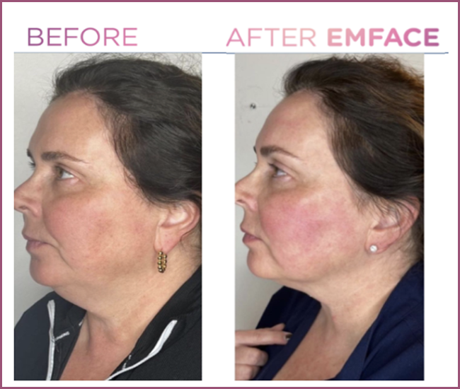 after_emface_2